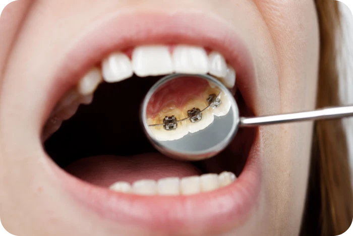 ppareil d’orthodontie linguale avec attaches placées sur la face interne des dents